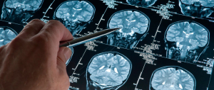 Alzheimer: è lo stile di vita che può aiutare a contrastare la malattia
