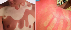 Ecco l’ennesima follia social: tutti pazzi per il tatuaggio solare
