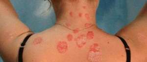 Psoriasi, in tre milioni ne soffrono. Ma in Italia la cura non è uguale per tutti