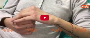 Il dolore e la speranza di Gessica, l’ex miss sfregiata con l’acido dal ragazzo (video)