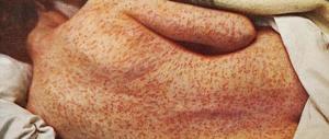 Morbillo, è epidemia in Italia: +230%. E gli Usa ci mettono sulla lista nera