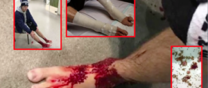 Si tuffa in mare, “creature misteriose” gli divorano a sangue le gambe (video)