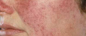 Salute, l’indagine: una persona su cinque “sotto scacco” della rosacea
