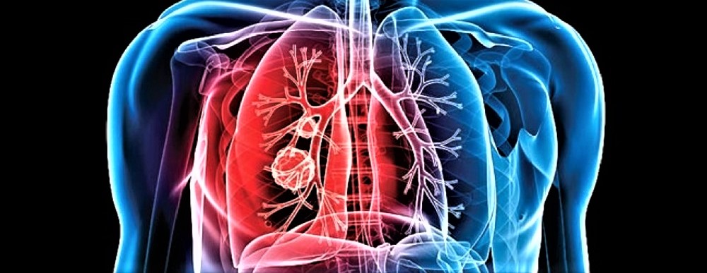 Altri casi di tubercolosi a Roma e Torino: ma non era scomparsa?