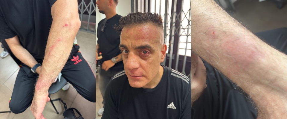 Cicalone aggredito a Napoli: “Erano due africani, uno mi ha colpito con un bastone e ha cercato di rubare la telecamera”