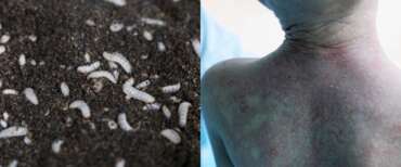 Larva mangia-carne: allarme dagli Usa, c’è un paziente zero. Finora il parassita non aveva mai attaccato l’uomo