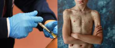 Allarme morbillo in Gran Bretagna: l’Oms toglie il bollino di “Paese libero”