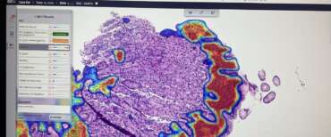 Tumori, la svolta nelle diagnosi arriva da Roma: «Con l’intelligenza artificiale referti più veloci del 30%»