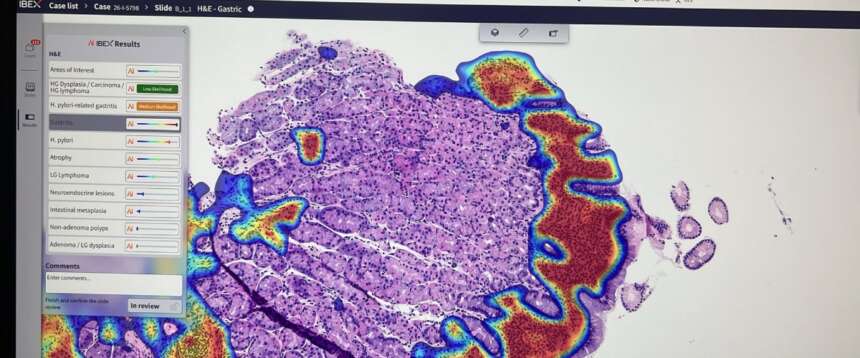 Tumori, la svolta nelle diagnosi arriva da Roma: «Con l’intelligenza artificiale referti più veloci del 30%»