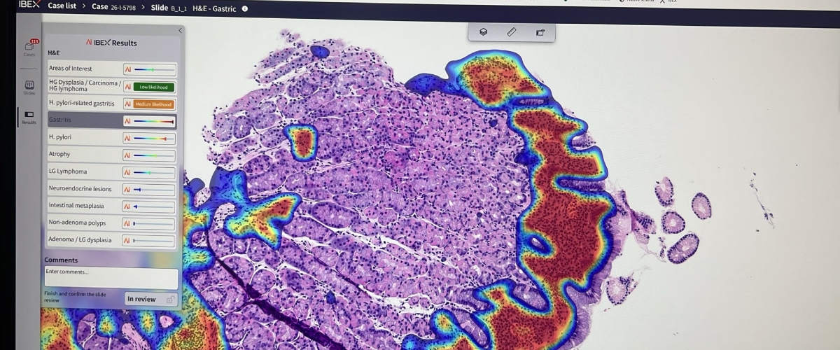 tumori la svolta nelle diagnosi arriva da roma con l8217intelligenza artificiale referti pi249 veloci del 30 da Secoloditalia.it tumori la svolta nelle diagnosi arriva da roma con l8217intelligenza artificiale referti pi249 veloci del 30